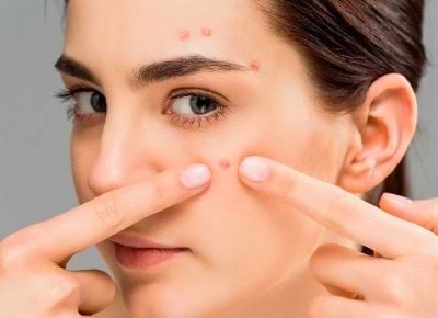Jangan Asal Garuk, Ketahui Perbedaan Jerawat dan Cacar Monyet. (Foto: Perbedaan Jerawat dan Cacar Monyet)