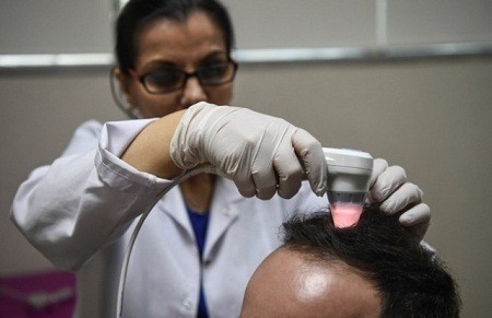 Intip Biaya Transplantasi Rambut di Beberapa Negara, Tembus Puluhan Juta Rupiah. (Foto: MNC Media)