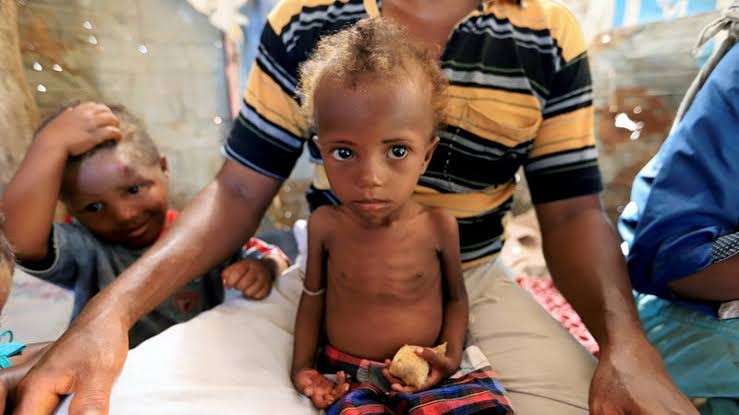 UNICEF Sebut 700 Ribu Anak di Sudan Alami Kekurangan Gizi (FOTO:MNC Media)