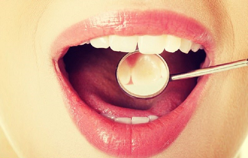 Intip Kisaran Biaya Bersihkan Karang Gigi. (Foto: MNC Media)