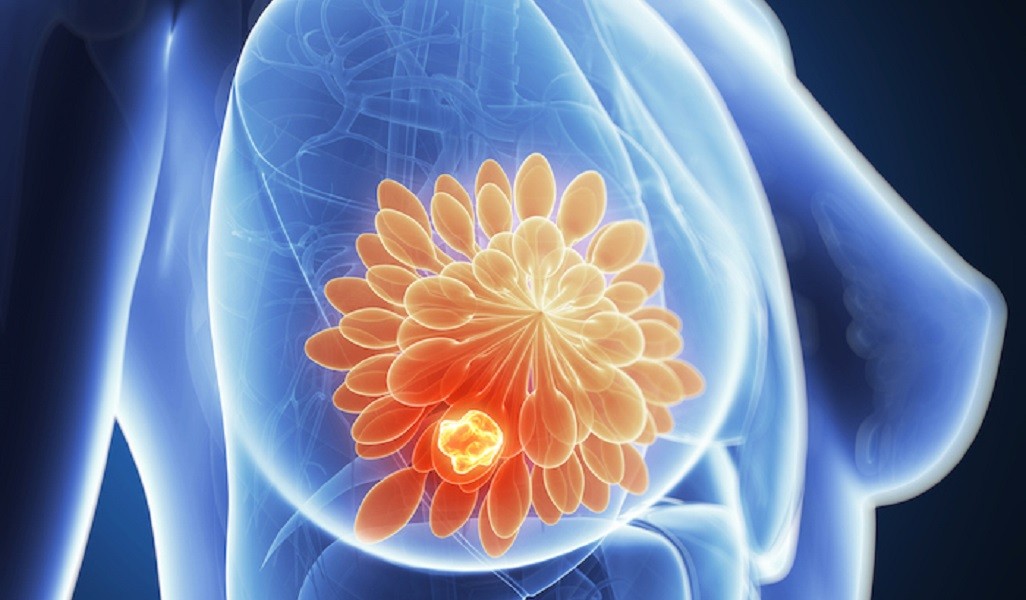 Punya Riwayat Kanker dalam Keluarga? Dokter Ingatkan Jangan Asal Tes Genetik. (Foto: Parkway cancer centre)