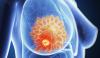Punya Riwayat Kanker dalam Keluarga? Dokter Ingatkan Jangan Asal Tes Genetik. (Foto: Parkway cancer centre)