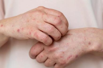 Beberapa negara telah mengumumkan situasi darurat monkeypox atau cacar monyet.