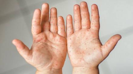 Ini Dua Kelompok Risiko Tinggi yang Dapat Vaksin Mpox (FOTO:MNC Media)