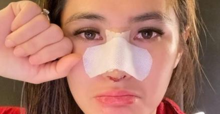 Cek Biaya Operasi Hidung Lengkap dengan Prosedurnya. (Foto: MNC Media) 
