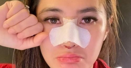 Cek Biaya Operasi Hidung Lengkap dengan Prosedurnya 