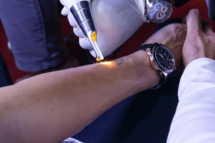 Petugas menghapus tinta tato dengan menggunakan laser saat kegiatan hapus tato gratis di Kantor Sekretariat DPP Forum Ulama Habaib (Fuhab), Jakarta Selatan.